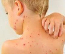 Сыпь на коже при вирусных инфекциях у детей